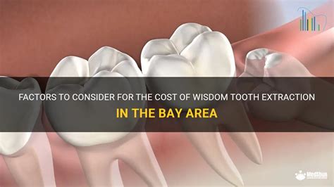 affordable wisdom tooth removal bay area
